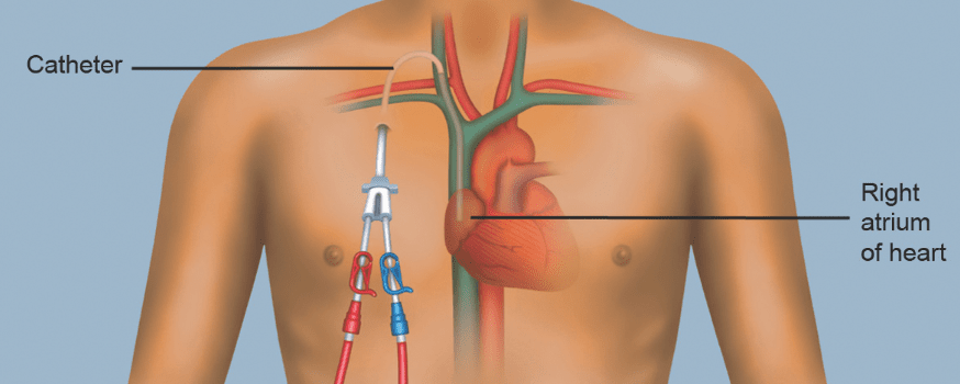 Hemodialysis catheter